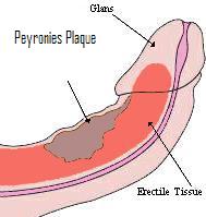 peyronies curvature